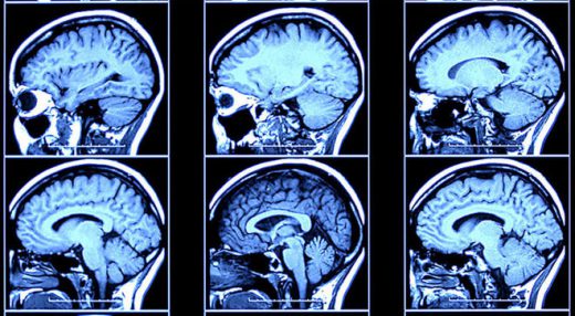 brain scan